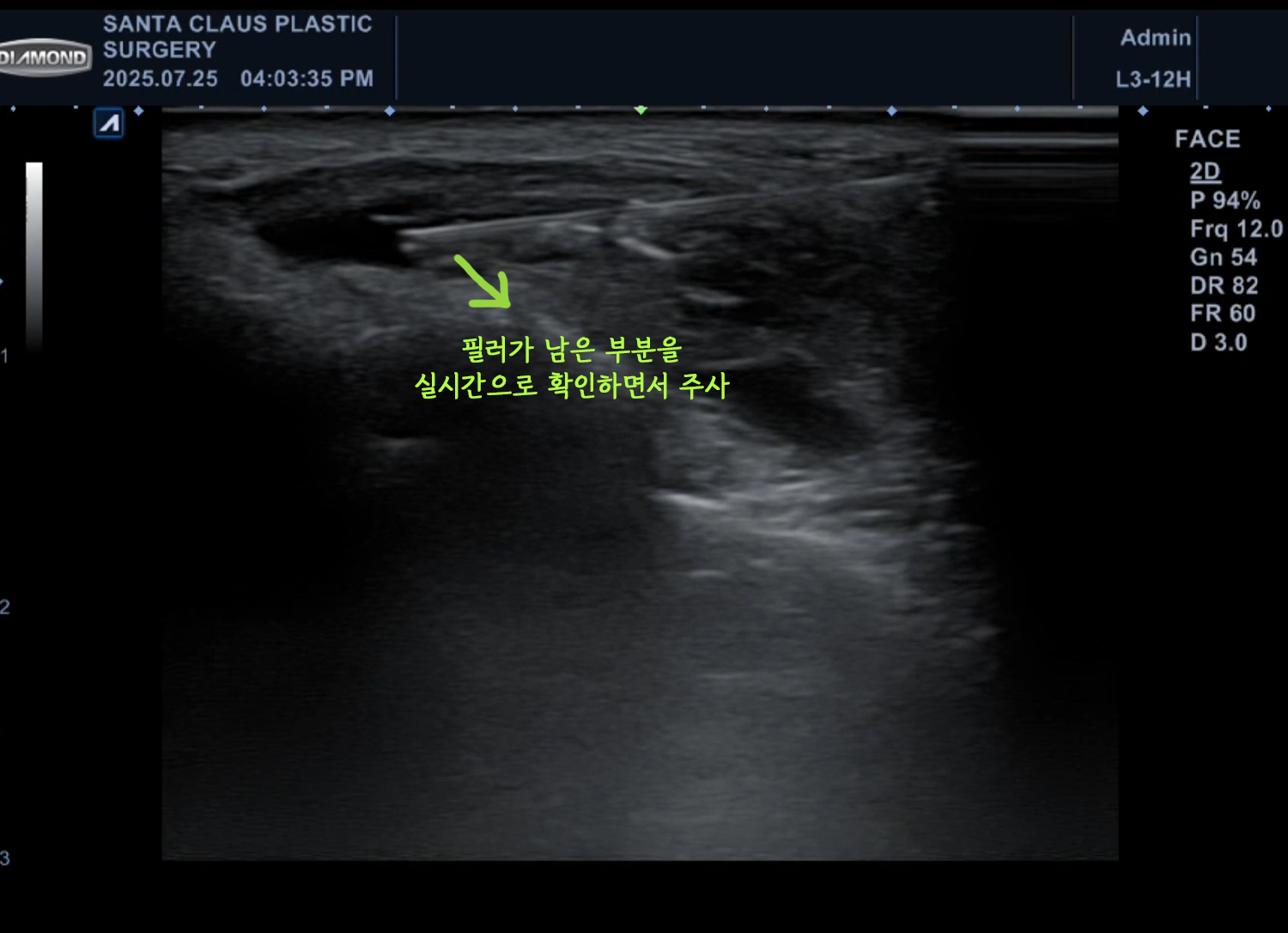초음파 히알라제