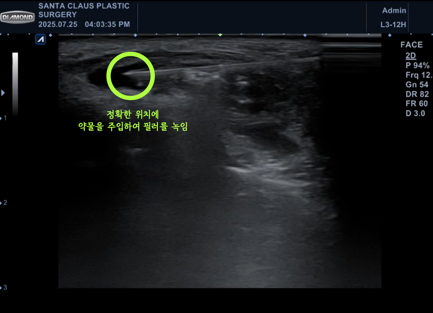 초음파필러녹이는주사 잘하는 곳