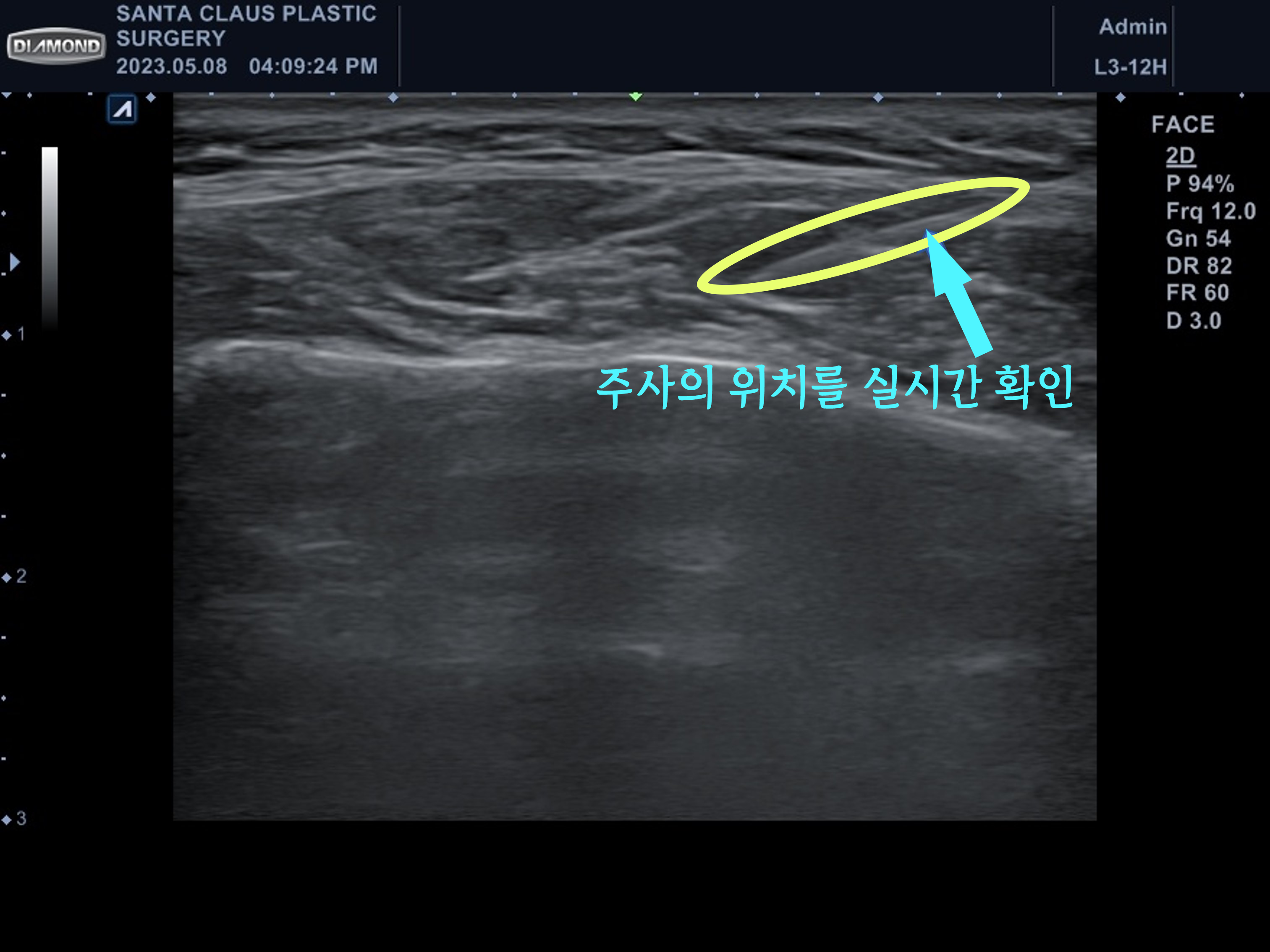 잠실 초음파 보톡스