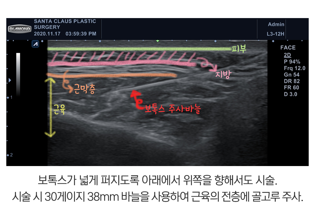 잠실 초음파 보톡스