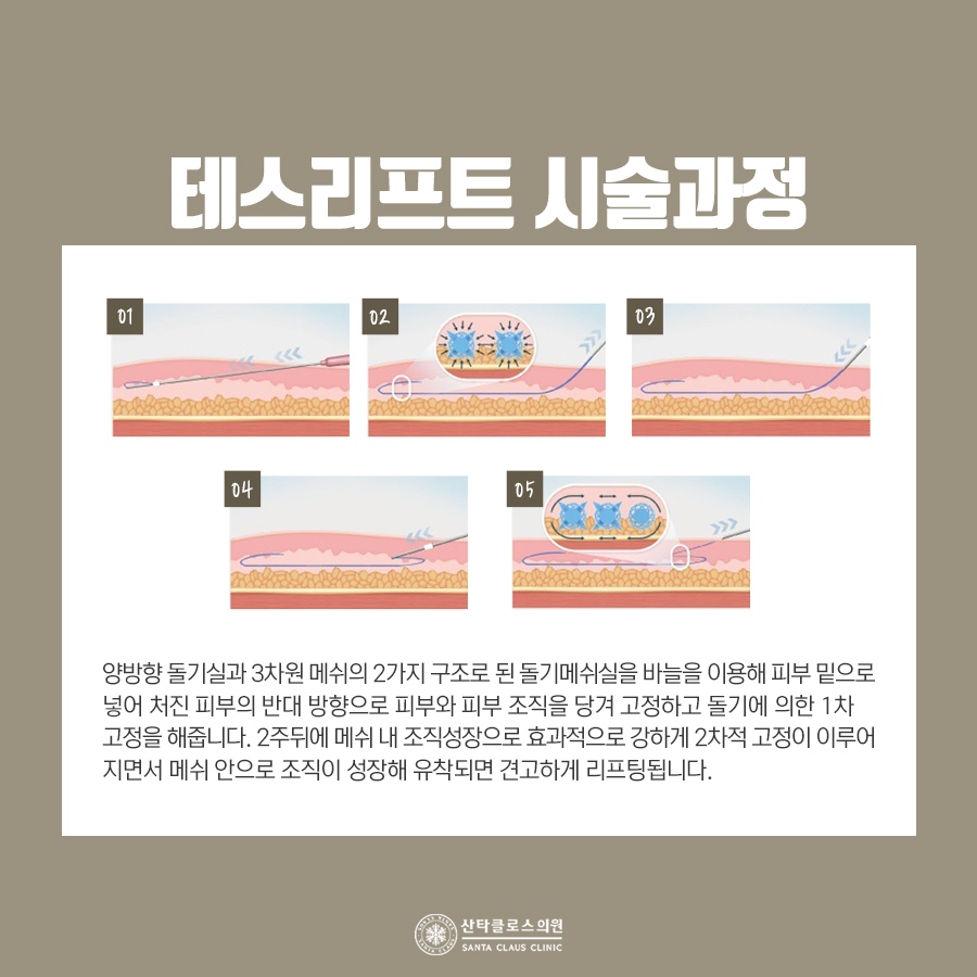 잠실실리프팅 잘하는곳