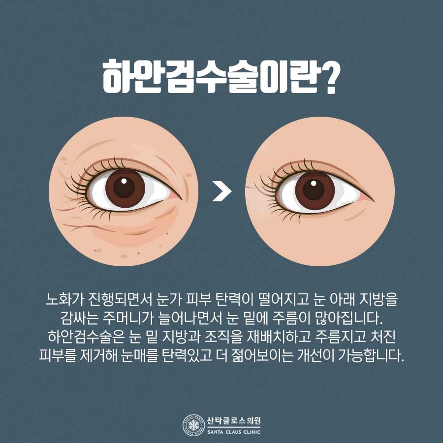 잠실하안검수술