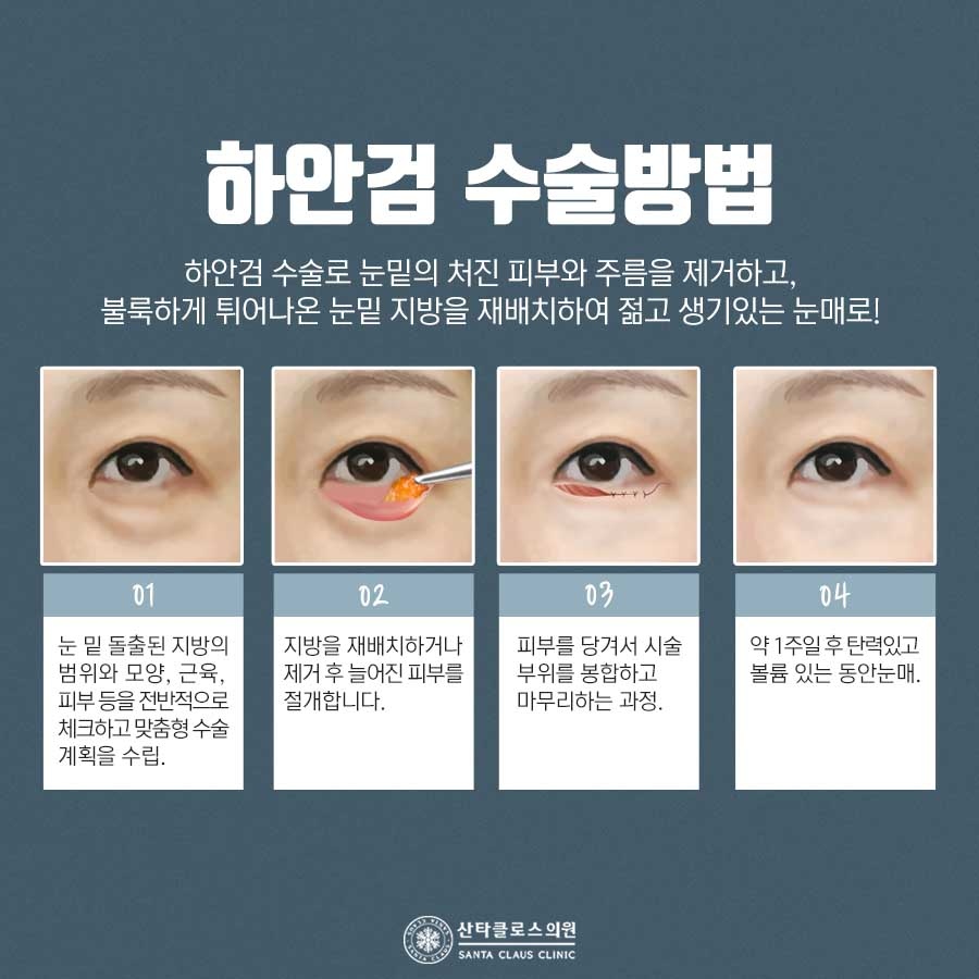 잠실하안검수술
