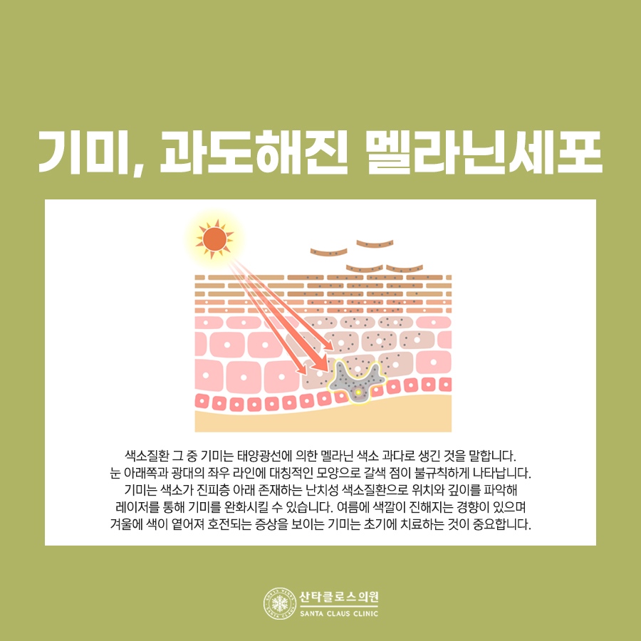 잠실색소치료
