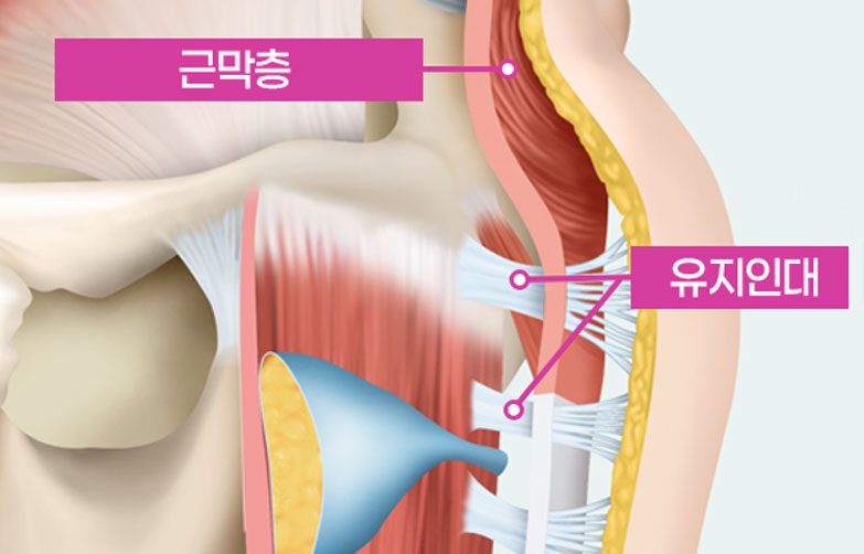 유지인대재생술